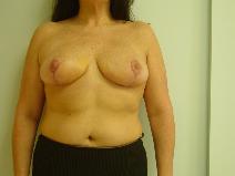 Breast Reduction After Photo by Neal Goldberg, MD; Scarsdale, NY - Case 8172