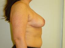 Breast Reduction After Photo by Neal Goldberg, MD; Scarsdale, NY - Case 8172