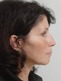 Facelift After Photo by Neal Goldberg, MD; Scarsdale, NY - Case 9008