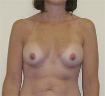 Breast Augmentation After Photo by Neal Goldberg, MD; Scarsdale, NY - Case 9009