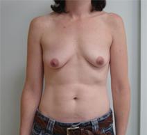 Breast Augmentation Before Photo by Neal Goldberg, MD; Scarsdale, NY - Case 9009