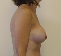 Breast Augmentation After Photo by Neal Goldberg, MD; Scarsdale, NY - Case 9009