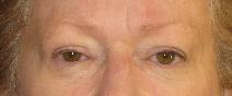 Eyelid Surgery After Photo by Neal Goldberg, MD; Scarsdale, NY - Case 9010