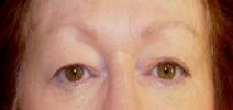 Eyelid Surgery Before Photo by Neal Goldberg, MD; Scarsdale, NY - Case 9010