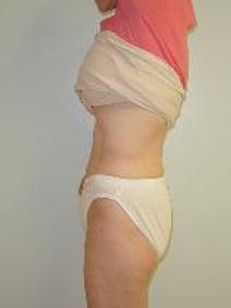 Tummy Tuck After Photo by Neal Goldberg, MD; Scarsdale, NY - Case 9011