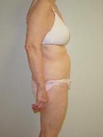 Tummy Tuck Before Photo by Neal Goldberg, MD; Scarsdale, NY - Case 9011