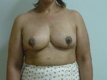 Breast Reconstruction After Photo by Neal Goldberg, MD; Scarsdale, NY - Case 9012