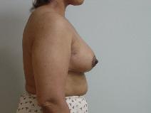 Breast Reconstruction After Photo by Neal Goldberg, MD; Scarsdale, NY - Case 9012