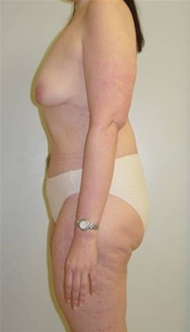 Body Contouring After Photo by Neal Goldberg, MD; Scarsdale, NY - Case 9253