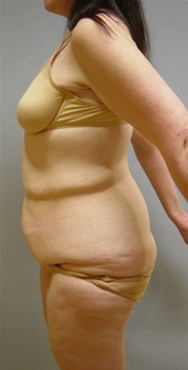 Body Contouring Before Photo by Neal Goldberg, MD; Scarsdale, NY - Case 9253