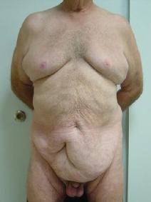 Body Contouring Before Photo by Neal Goldberg, MD; Scarsdale, NY - Case 9254