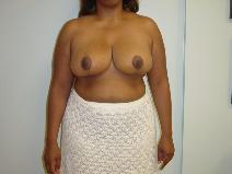 Breast Reduction After Photo by Neal Goldberg, MD; Scarsdale, NY - Case 9256