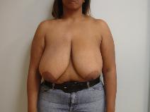 Breast Reduction Before Photo by Neal Goldberg, MD; Scarsdale, NY - Case 9256