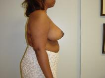 Breast Reduction After Photo by Neal Goldberg, MD; Scarsdale, NY - Case 9256