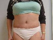 Tummy Tuck After Photo by Neal Goldberg, MD; Scarsdale, NY - Case 9257