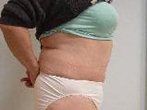Tummy Tuck After Photo by Neal Goldberg, MD; Scarsdale, NY - Case 9257