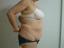Tummy Tuck Before Photo by Neal Goldberg, MD; Scarsdale, NY - Case 9257