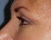 Eyelid Surgery After Photo by Neal Goldberg, MD; Scarsdale, NY - Case 9276