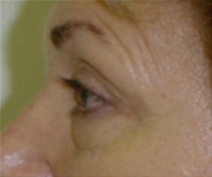 Eyelid Surgery Before Photo by Neal Goldberg, MD; Scarsdale, NY - Case 9276