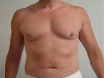 Liposuction After Photo by Neal Goldberg, MD; Scarsdale, NY - Case 9277