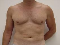 Liposuction Before Photo by Neal Goldberg, MD; Scarsdale, NY - Case 9277