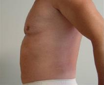 Liposuction After Photo by Neal Goldberg, MD; Scarsdale, NY - Case 9277