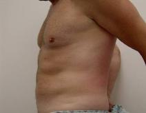 Liposuction Before Photo by Neal Goldberg, MD; Scarsdale, NY - Case 9277