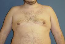 Male Breast Reduction After Photo by Neal Goldberg, MD; Scarsdale, NY - Case 9307