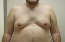 Male Breast Reduction Before Photo by Neal Goldberg, MD; Scarsdale, NY - Case 9307