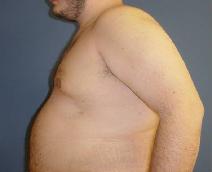 Male Breast Reduction After Photo by Neal Goldberg, MD; Scarsdale, NY - Case 9307