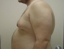 Male Breast Reduction Before Photo by Neal Goldberg, MD; Scarsdale, NY - Case 9307