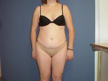 Tummy Tuck Before Photo by Neal Goldberg, MD; Scarsdale, NY - Case 9658