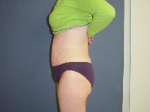 Tummy Tuck After Photo by Neal Goldberg, MD; Scarsdale, NY - Case 9658