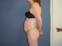 Tummy Tuck Before Photo by Neal Goldberg, MD; Scarsdale, NY - Case 9658