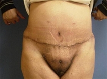 Body Contouring After Photo by Neal Goldberg, MD; Scarsdale, NY - Case 9659