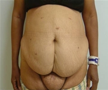 Body Contouring Before Photo by Neal Goldberg, MD; Scarsdale, NY - Case 9659