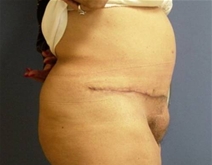 Body Contouring After Photo by Neal Goldberg, MD; Scarsdale, NY - Case 9659