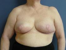Breast Reconstruction After Photo by Neal Goldberg, MD; Scarsdale, NY - Case 9660
