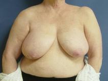 Breast Reconstruction Before Photo by Neal Goldberg, MD; Scarsdale, NY - Case 9660