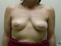 Breast Reconstruction After Photo by Neal Goldberg, MD; Scarsdale, NY - Case 9661