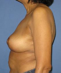 Breast Lift After Photo by Neal Goldberg, MD; Scarsdale, NY - Case 9685