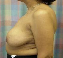 Breast Lift Before Photo by Neal Goldberg, MD; Scarsdale, NY - Case 9685