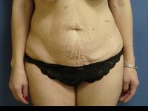 Tummy Tuck Before Photo by Neal Goldberg, MD; Scarsdale, NY - Case 9908