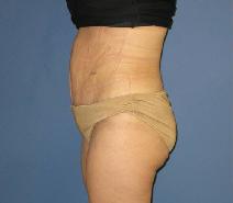 Tummy Tuck After Photo by Neal Goldberg, MD; Scarsdale, NY - Case 9908