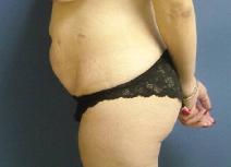 Tummy Tuck Before Photo by Neal Goldberg, MD; Scarsdale, NY - Case 9908