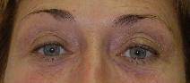 Eyelid Surgery After Photo by Neal Goldberg, MD; Scarsdale, NY - Case 9910