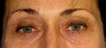 Eyelid Surgery Before Photo by Neal Goldberg, MD; Scarsdale, NY - Case 9910