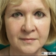 Facelift After Photo by Brian Buinewicz, MD; Doylestown, PA - Case 25212
