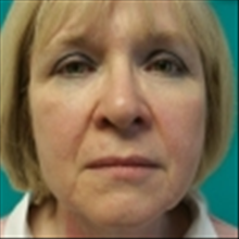 Facelift Before Photo by Brian Buinewicz, MD; Doylestown, PA - Case 25212