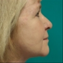 Facelift After Photo by Brian Buinewicz, MD; Doylestown, PA - Case 25212
